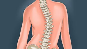 شناخت بیماری اسکولیوز، علائم و روش های درمان