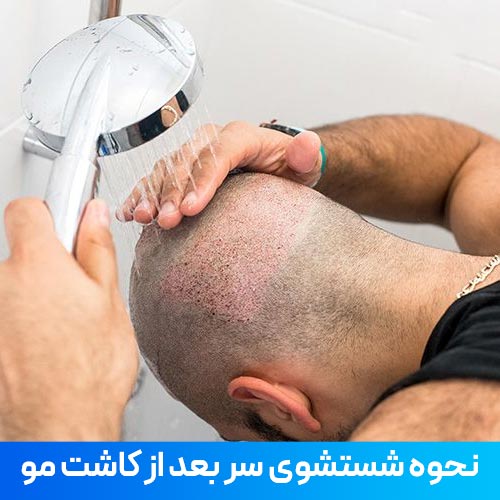 نحوه شستشوی سر و حمام بعد از کاشت موی طبیعی
