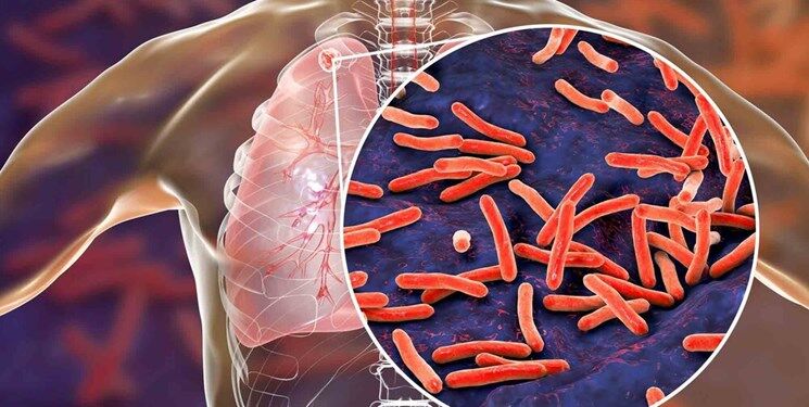 The use of antibiotic nanoparticles in the treatment of tuberculosis!
