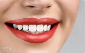 انتخاب بهترین نوع لمینت دندان