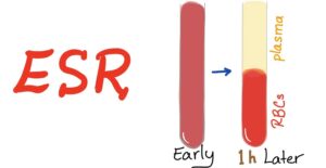 مقدار esr در سرطان خون چیست؟