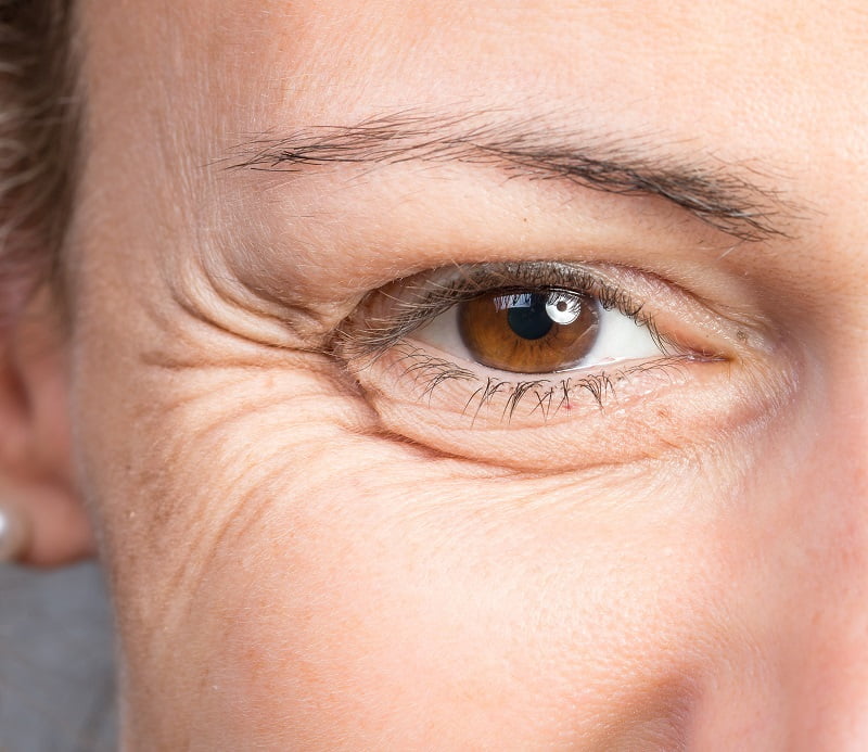 چشمانی شاداب: پیشگیری و درمان خطوط پنجه‌کلاغی