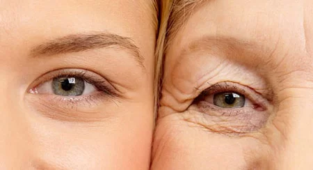 چشمانی شاداب: پیشگیری و درمان خطوط پنجه‌کلاغی