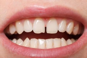 آیا ممکن است همزمان با بریس ارتودنسی، فاصله دندان ها زیادتر شود؟