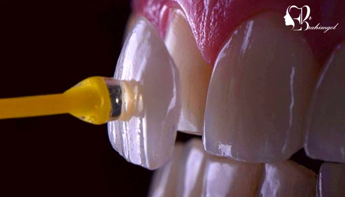 لمینت دندان چگونه انجام می شود؟ + مراحل دقیق، مزایا و معایب آن