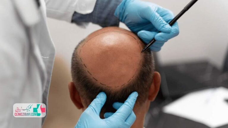 چگونه می توان به کلینیک های کاشت مو در شیراز و سایر شهرها اعتماد کرد؟