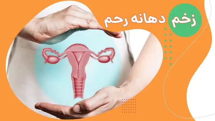 زخم دهانه رحم (سرویسیت): علل، علائم و روش‌های درمان