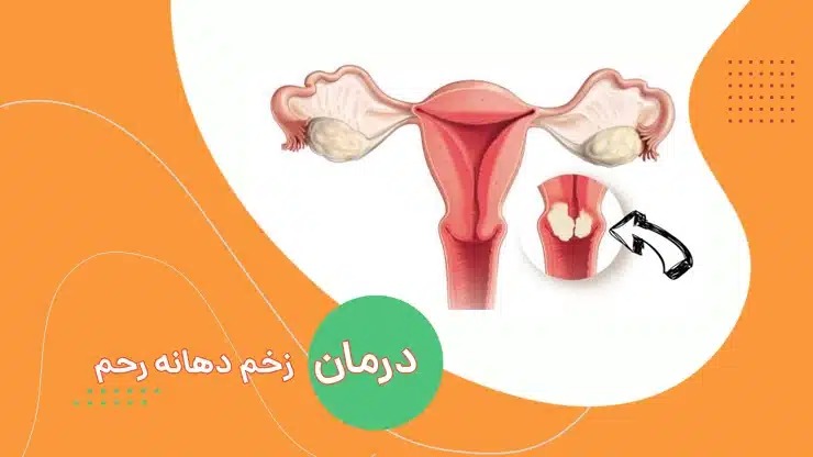 زخم دهانه رحم (سرویسیت): علل، علائم و روش‌های درمان