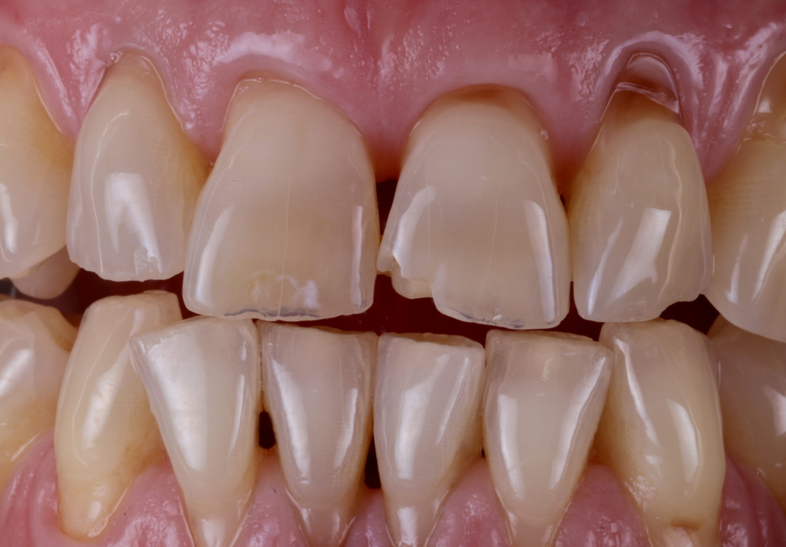 چگونه فک‌های کوچکتر ممکن است دندان‌های ما را فشرده کنند