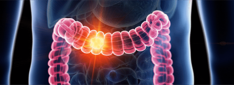 ۶ خوراکی مفید برای کاهش خطر سرطان روده