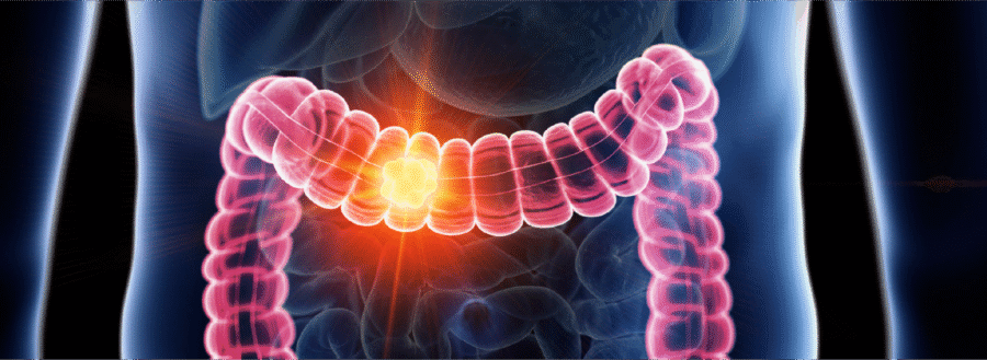 ۶ غذای مفید برای کاهش خطر سرطان روده