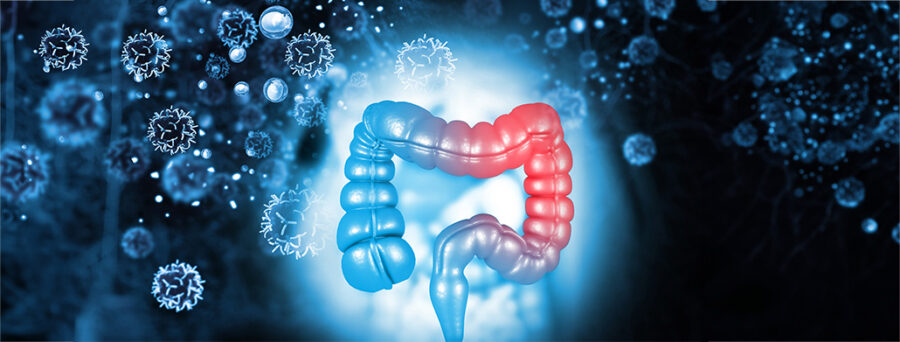 ۳ علامت هشدار سرطان روده که نباید نادیده بگیرید