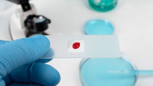 توسعه دستگاه ایرانی بینایی-بویایی برای تشخیص سریع سرطان خون