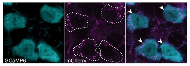 راز آغاز پارکینسون، سلولهای مغزی فرسوده مقصرند
