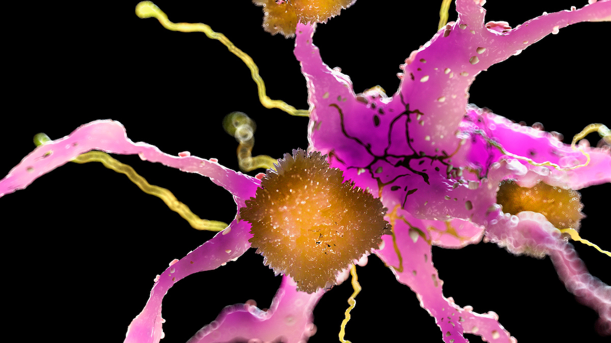 درمان تازه آلزایمر، پلاک‌های مغز را در چند ساعت زدود