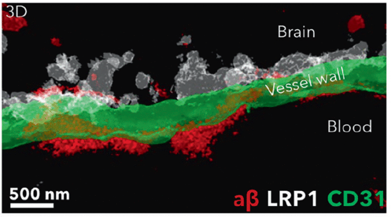 درمان تازه آلزایمر، پلاک‌های مغز را در چند ساعت زدود